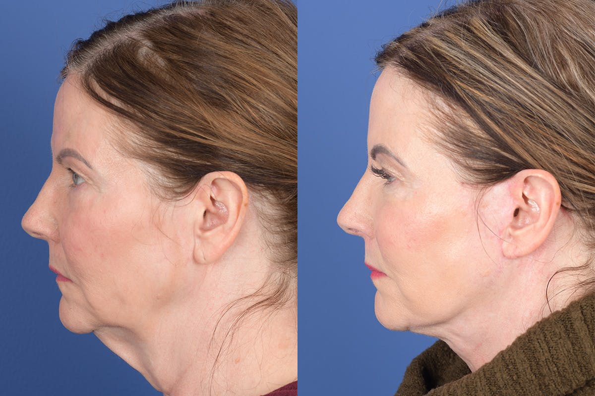 Facelift Before & After Gallery - Patient 368675 - Image 2