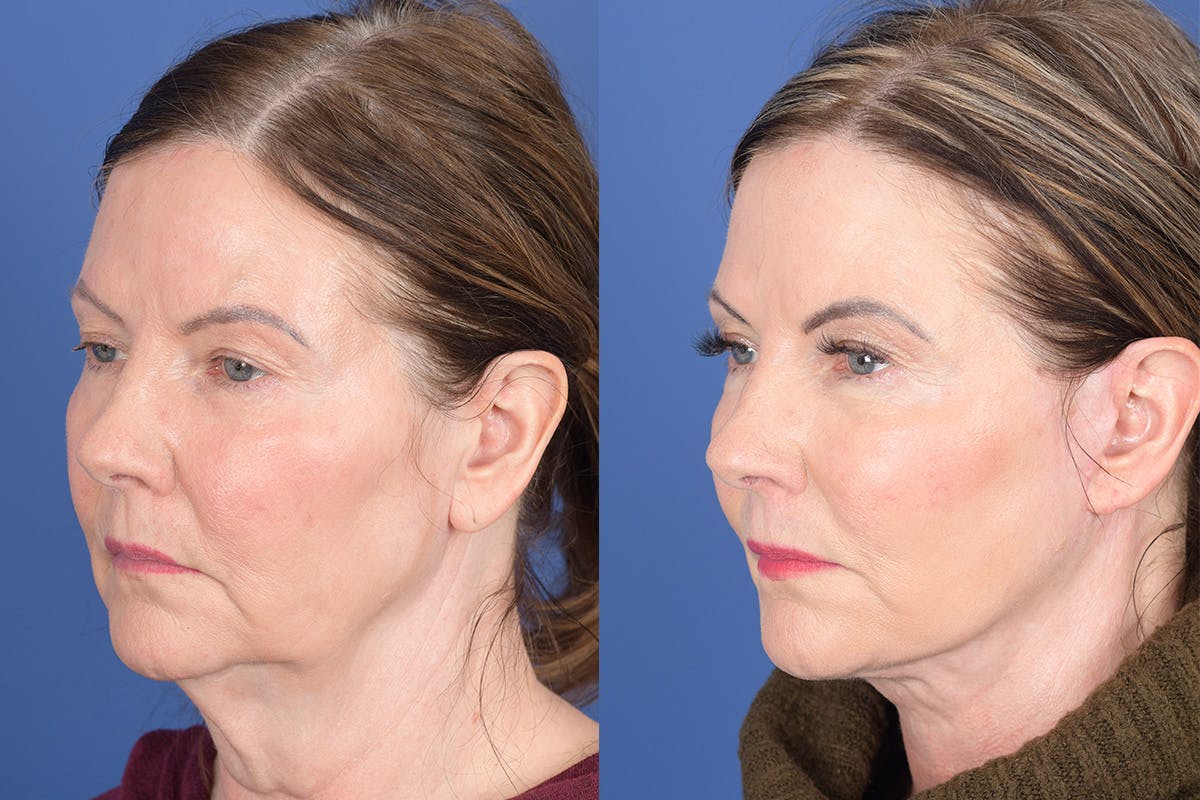 Facelift Before & After Gallery - Patient 368675 - Image 3