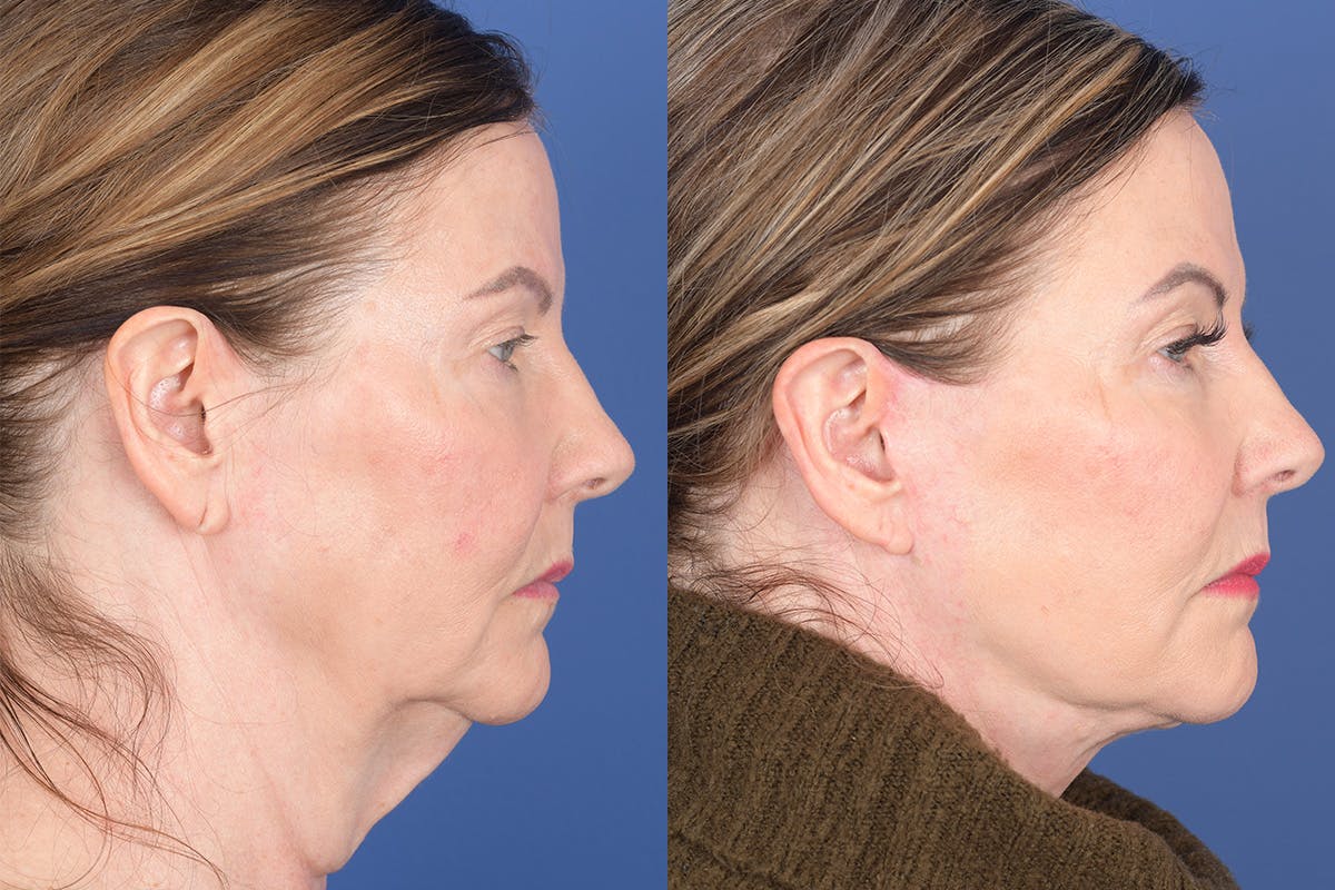 Facelift Before & After Gallery - Patient 368675 - Image 4