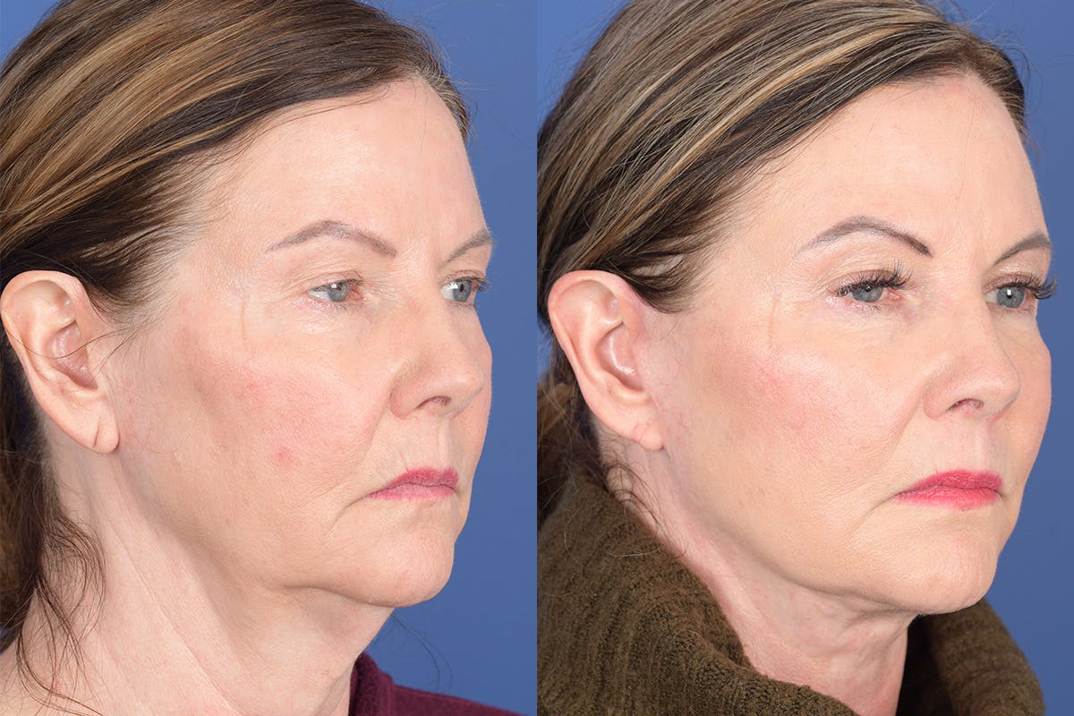 Facelift Before & After Gallery - Patient 368675 - Image 5