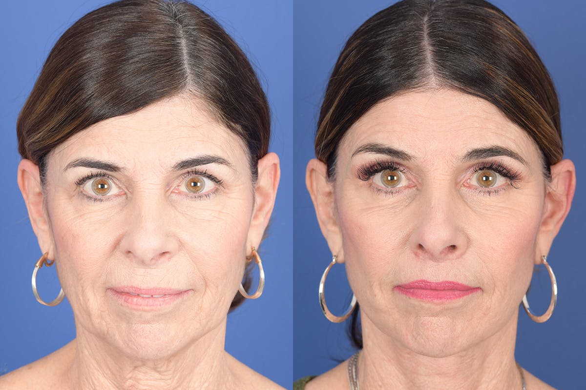Facelift Before & After Gallery - Patient 748592 - Image 1