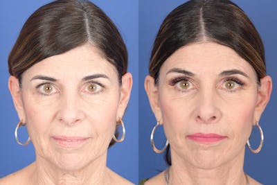 Facelift Before & After Gallery - Patient 748592 - Image 1