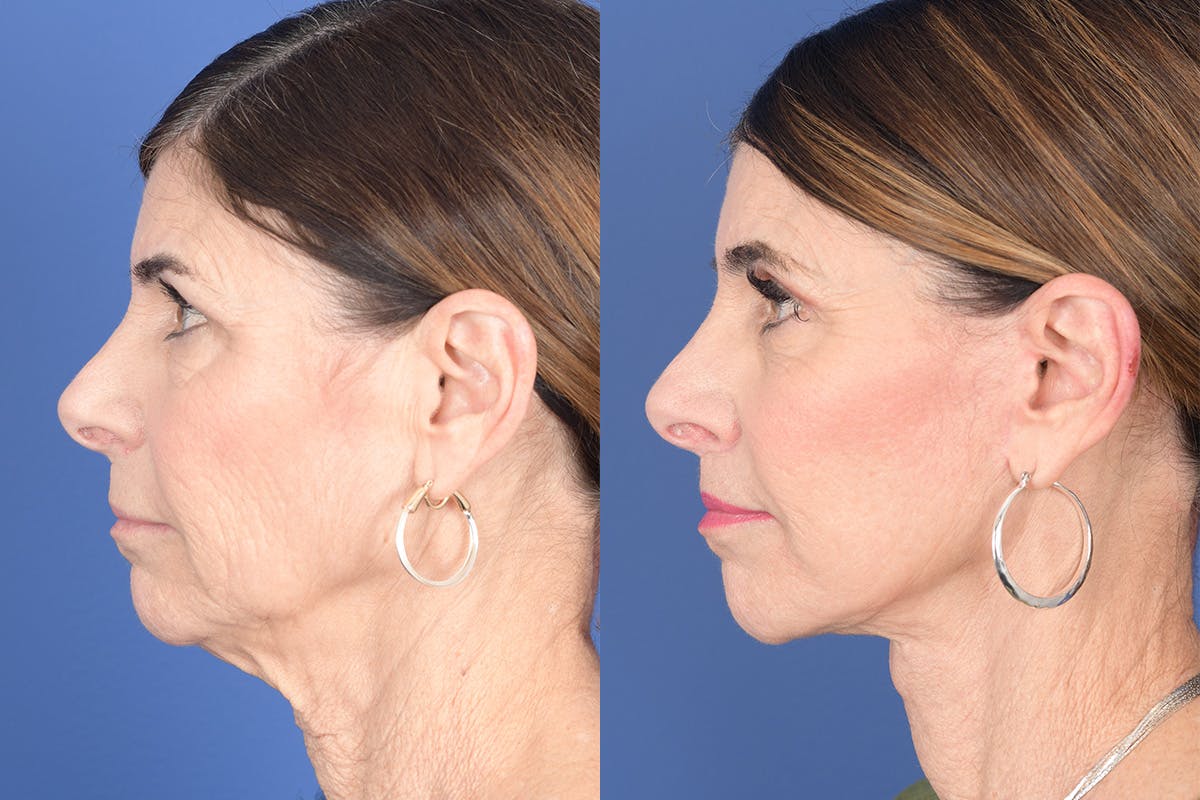 Facelift Before & After Gallery - Patient 748592 - Image 2