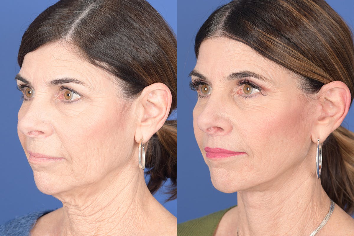 Facelift Before & After Gallery - Patient 748592 - Image 3