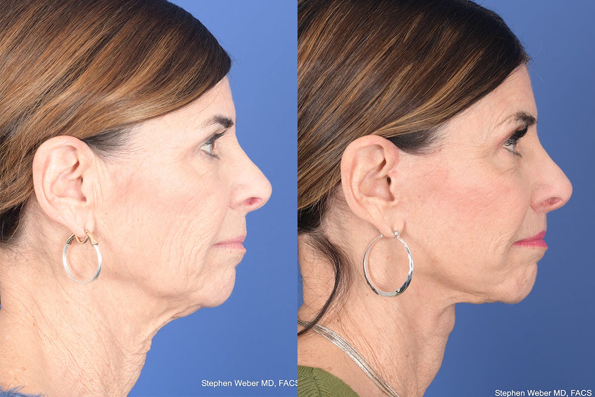 Facelift Before & After Gallery - Patient 748592 - Image 4