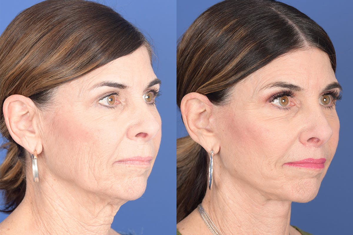Facelift Before & After Gallery - Patient 748592 - Image 5