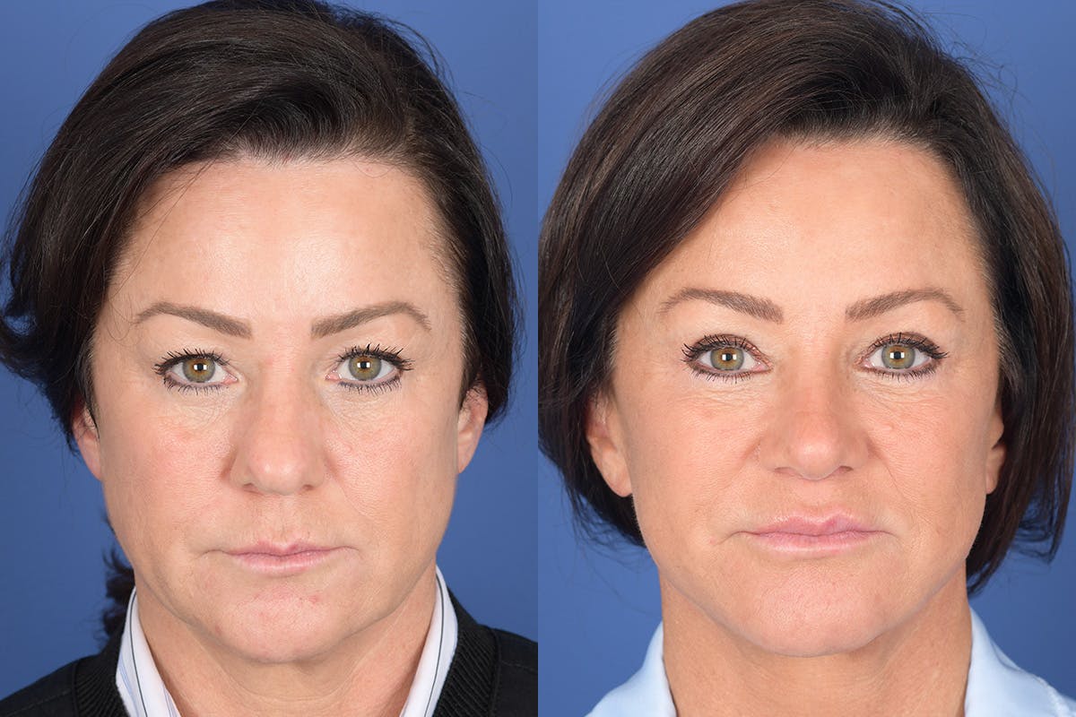 Facelift Before & After Gallery - Patient 186902 - Image 1
