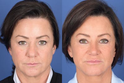 Facelift Before & After Gallery - Patient 186902 - Image 1