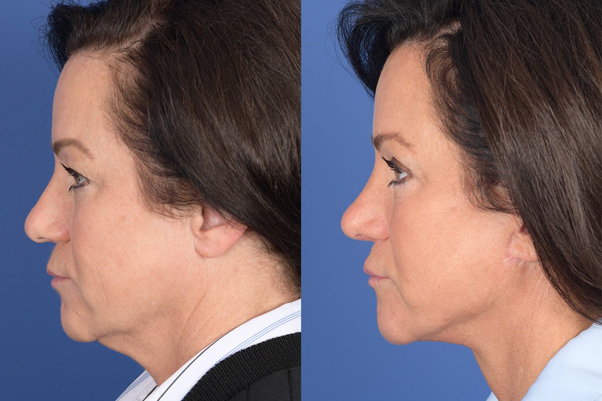 Facelift Before & After Gallery - Patient 186902 - Image 2