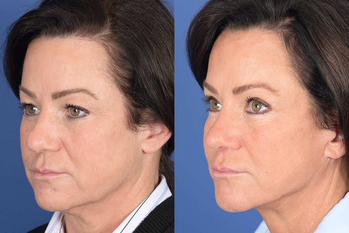 Facelift Before & After Gallery - Patient 186902 - Image 3