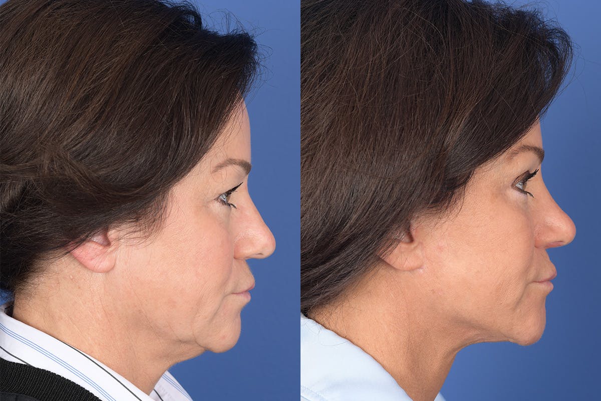 Facelift Before & After Gallery - Patient 186902 - Image 4