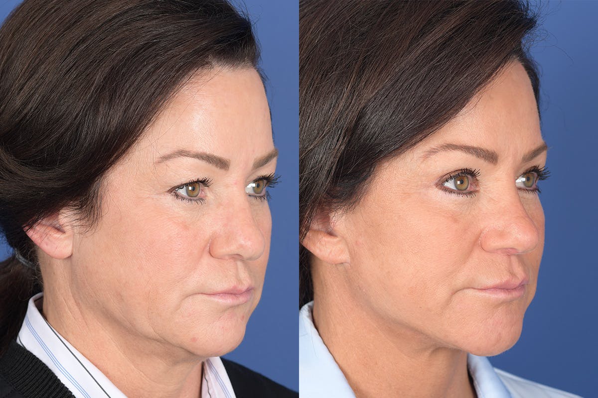 Facelift Before & After Gallery - Patient 186902 - Image 5