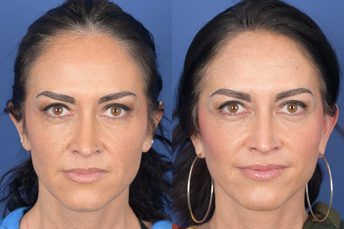 Facelift Before & After Gallery - Patient 104480 - Image 1