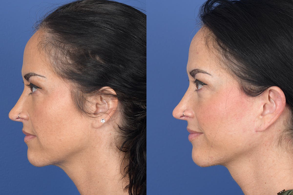 Facelift Before & After Gallery - Patient 104480 - Image 2