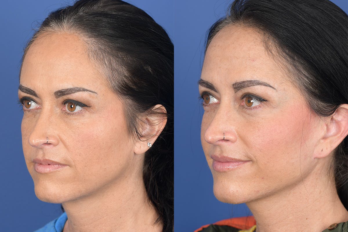 Facelift Before & After Gallery - Patient 104480 - Image 3