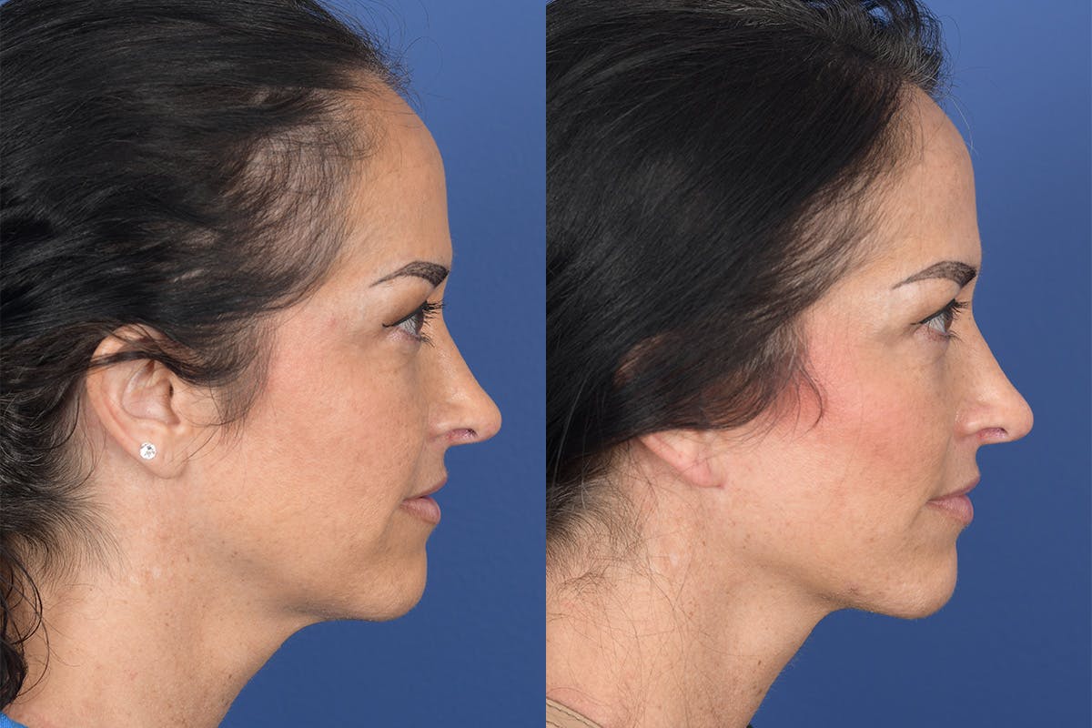 Facelift Before & After Gallery - Patient 104480 - Image 4