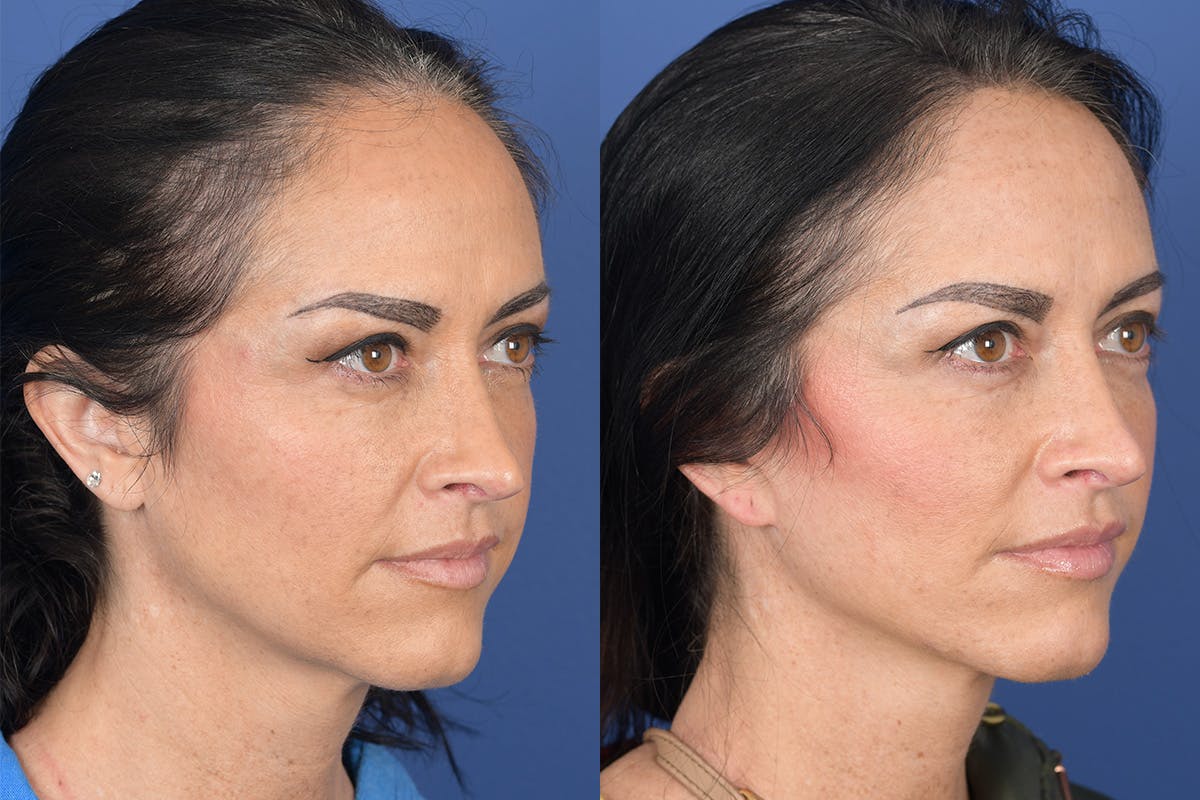 Facelift Before & After Gallery - Patient 104480 - Image 5