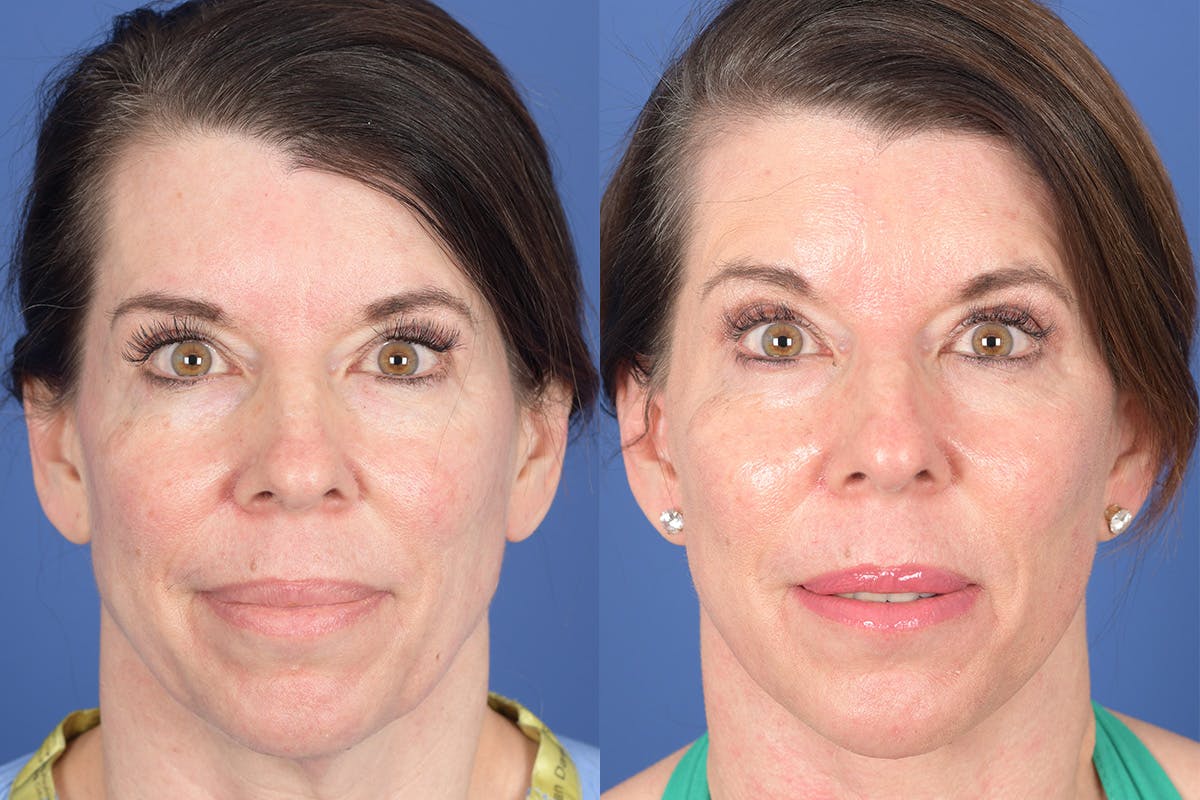 Facelift Before & After Gallery - Patient 921832 - Image 1