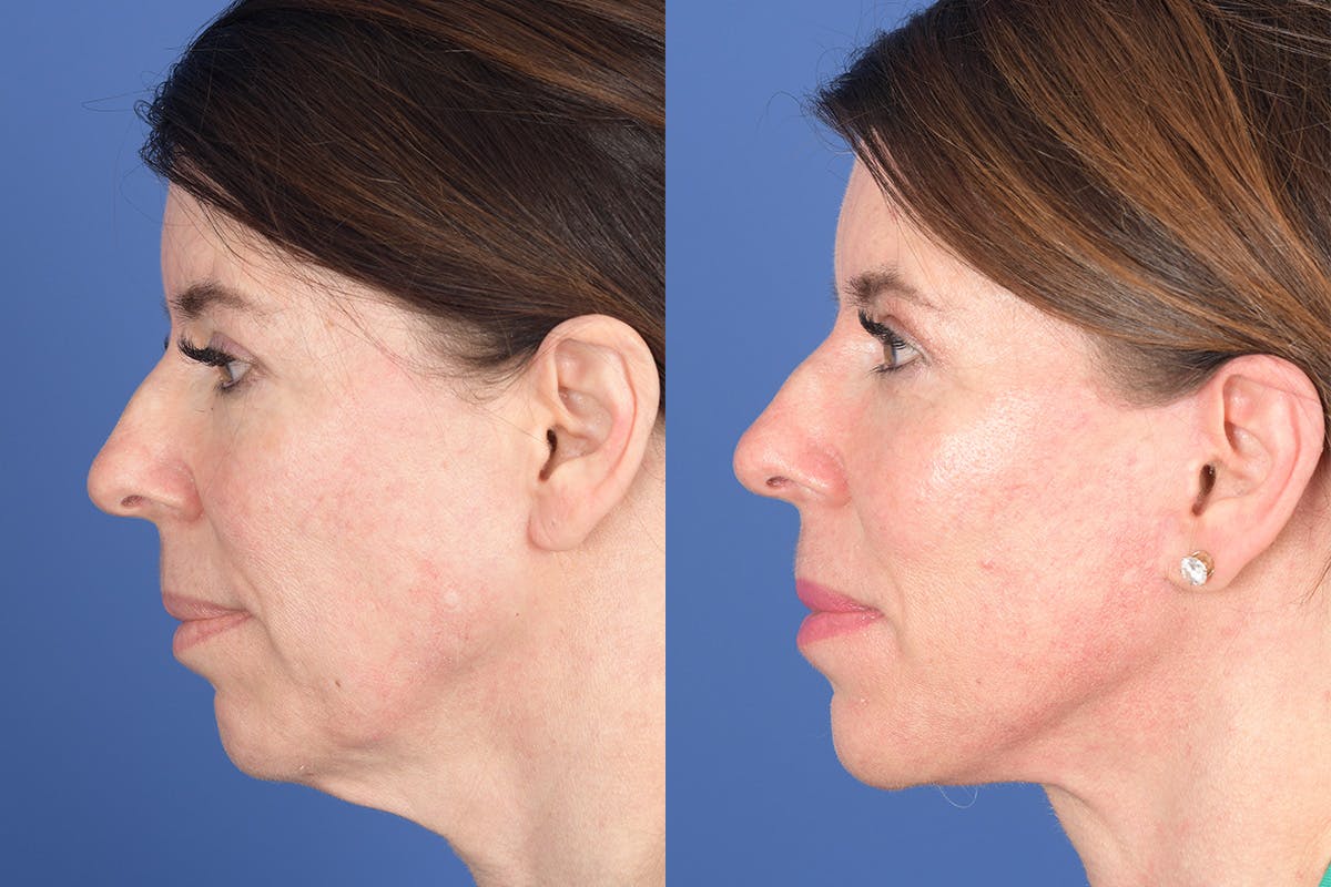 Facelift Before & After Gallery - Patient 921832 - Image 2