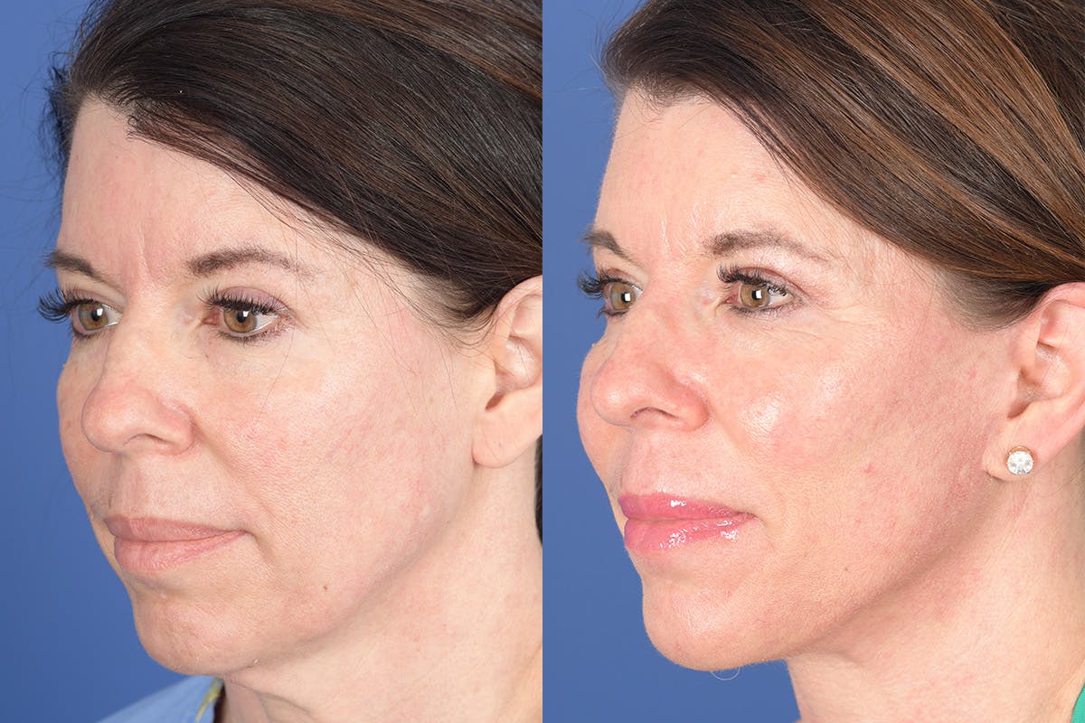 Facelift Before & After Gallery - Patient 921832 - Image 3