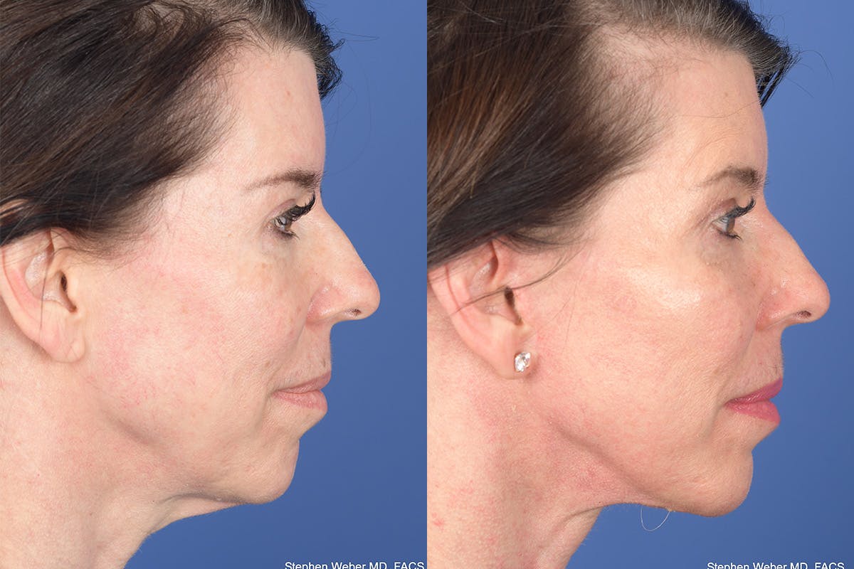 Facelift Before & After Gallery - Patient 921832 - Image 4