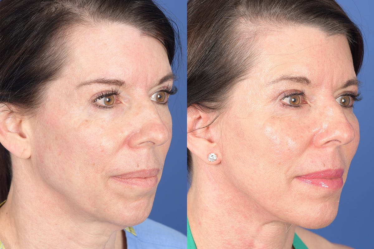 Facelift Before & After Gallery - Patient 921832 - Image 5