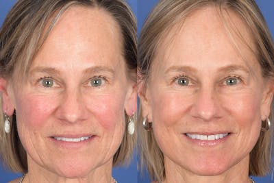 Facelift Before & After Gallery - Patient 380991 - Image 1
