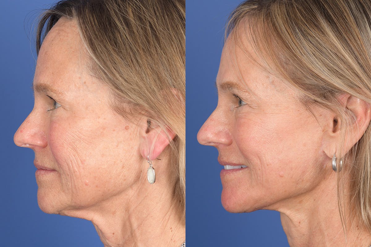 Facelift Before & After Gallery - Patient 380991 - Image 2