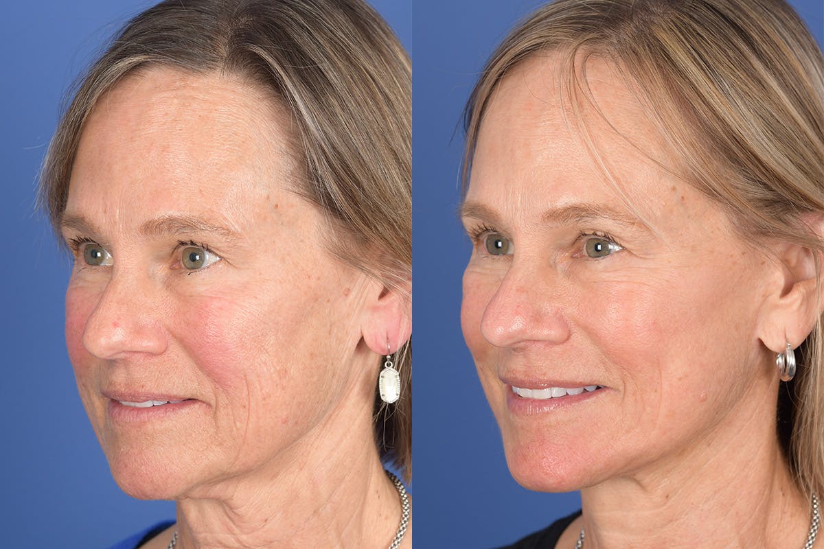 Facelift Before & After Gallery - Patient 380991 - Image 3