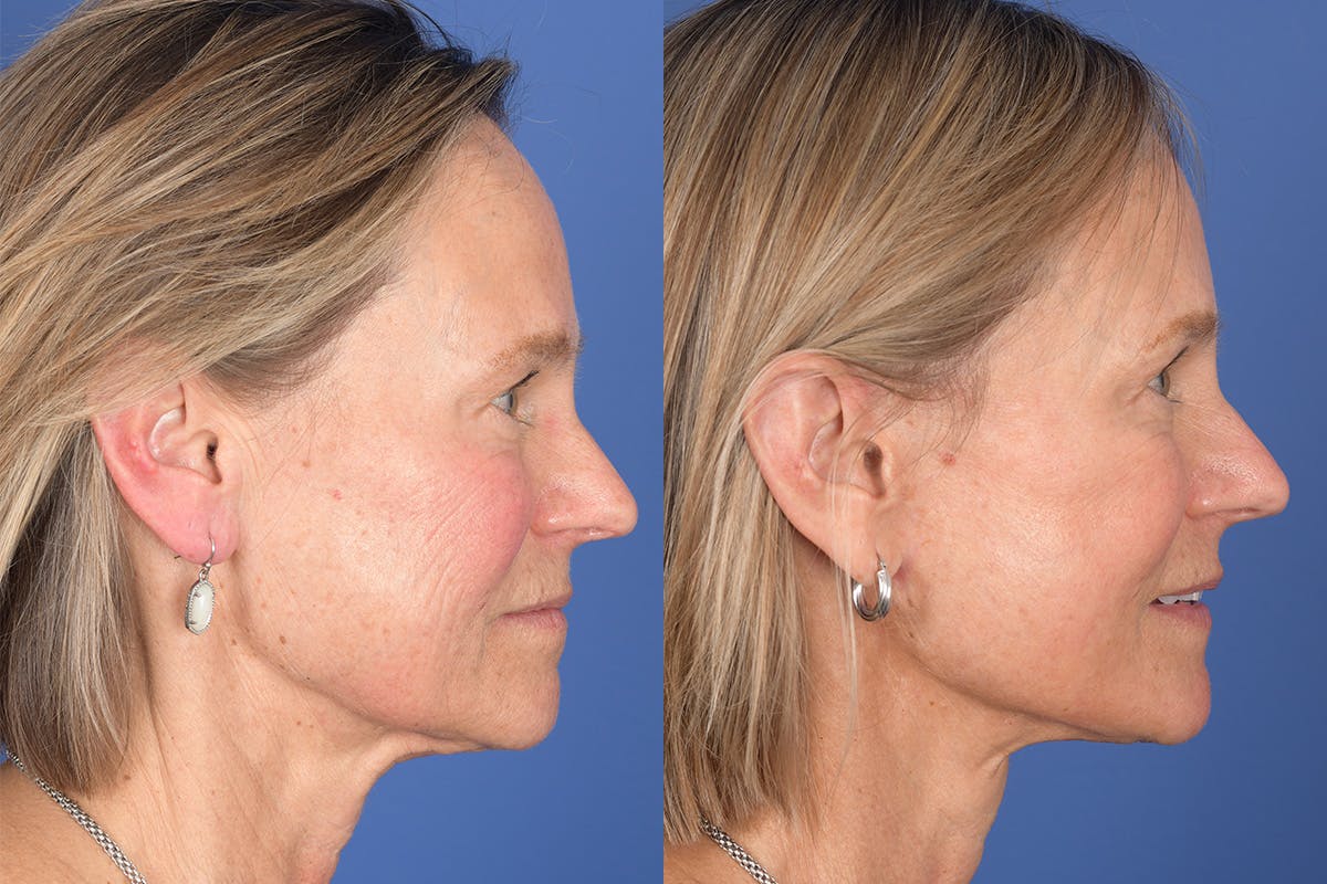 Facelift Before & After Gallery - Patient 380991 - Image 4