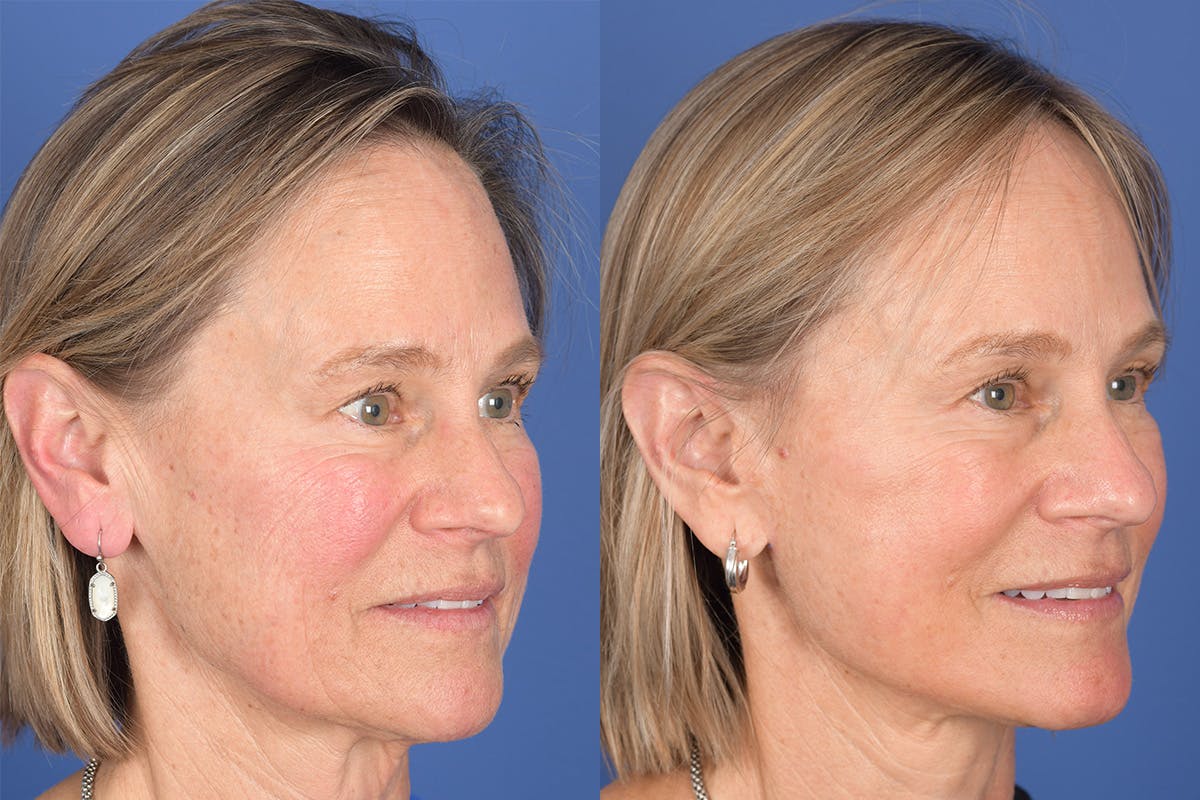 Facelift Before & After Gallery - Patient 380991 - Image 5