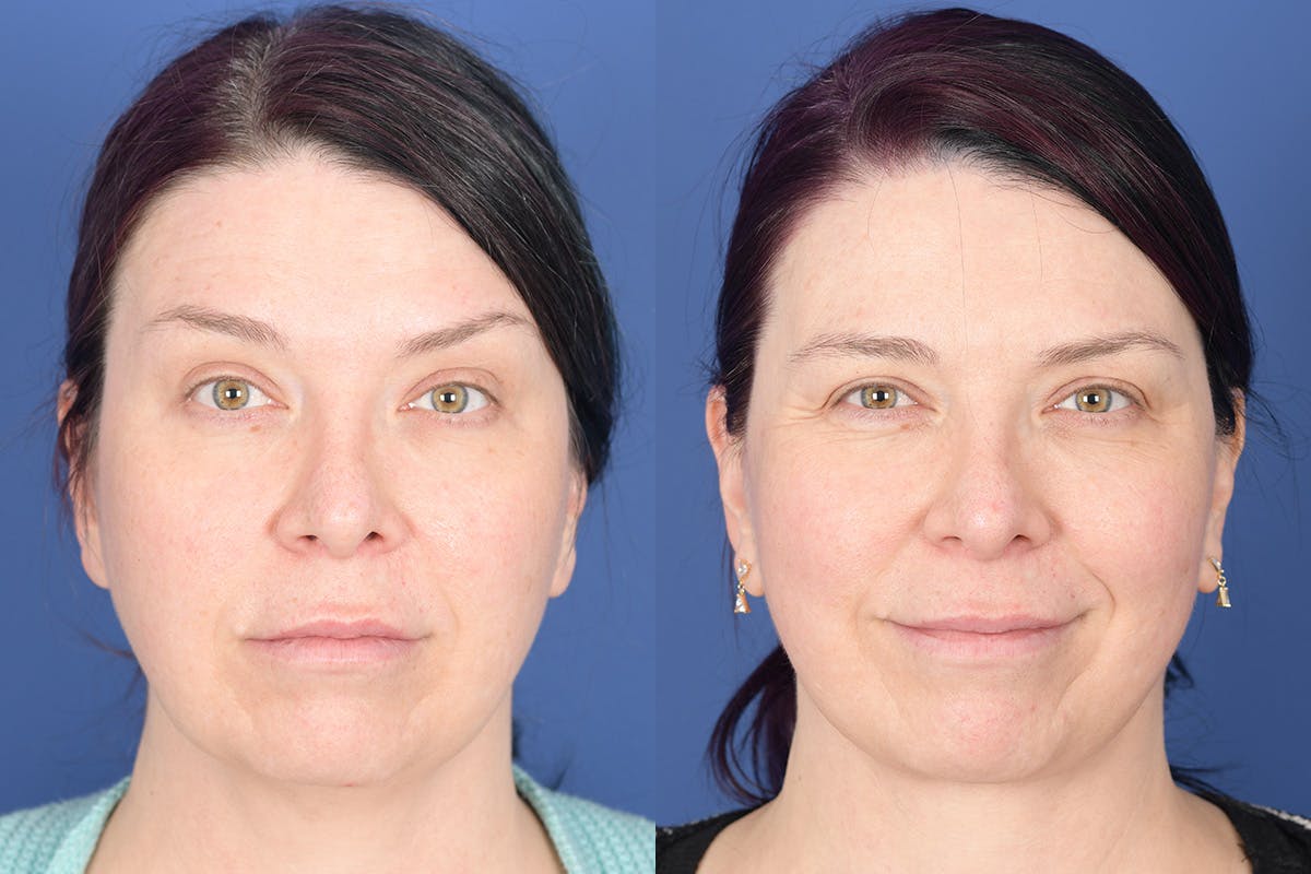 Facelift Before & After Gallery - Patient 318223 - Image 1