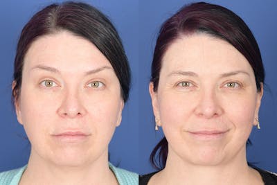 Facelift Before & After Gallery - Patient 318223 - Image 1