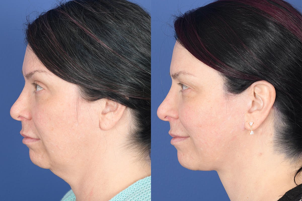 Facelift Before & After Gallery - Patient 318223 - Image 2
