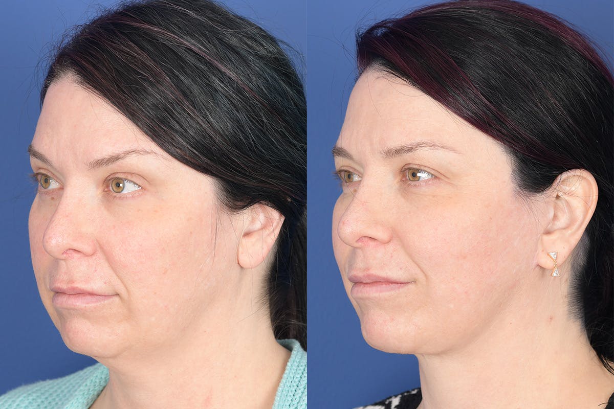 Facelift Before & After Gallery - Patient 318223 - Image 3