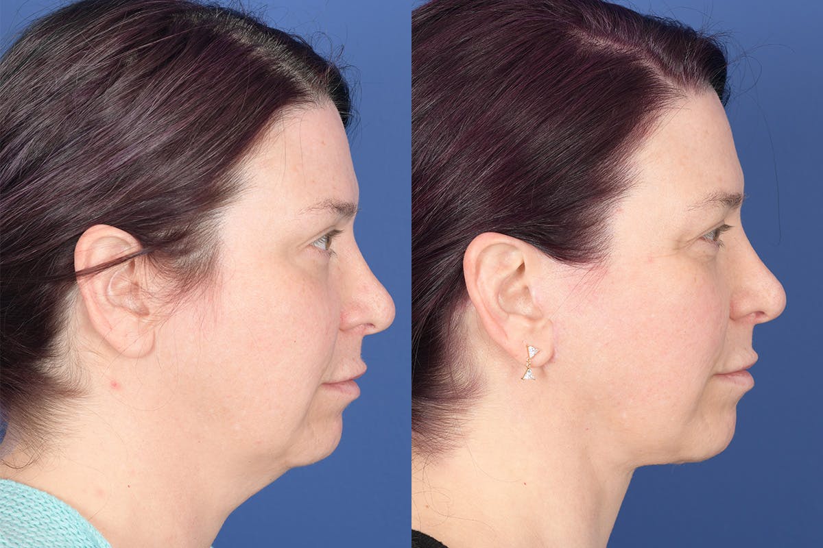 Facelift Before & After Gallery - Patient 318223 - Image 4
