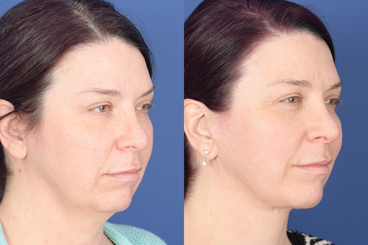 Facelift Before & After Gallery - Patient 318223 - Image 5