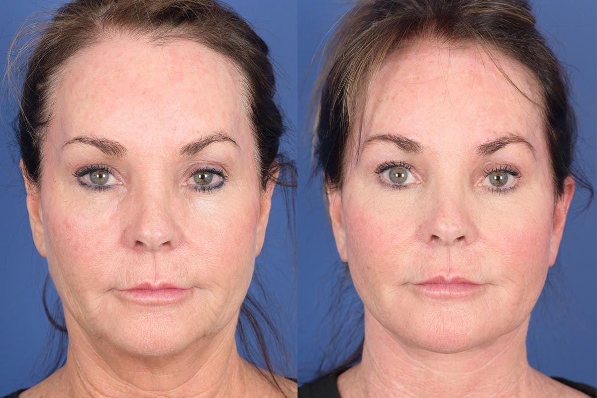 Facelift Before & After Gallery - Patient 381496 - Image 1