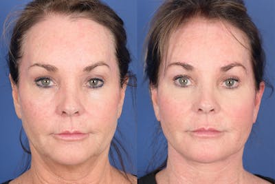 Facelift Before & After Gallery - Patient 381496 - Image 1