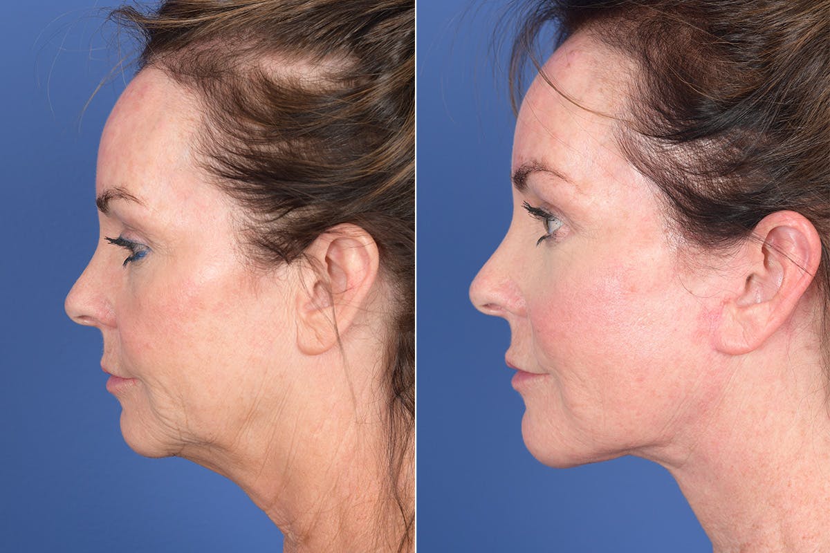 Facelift Before & After Gallery - Patient 381496 - Image 2