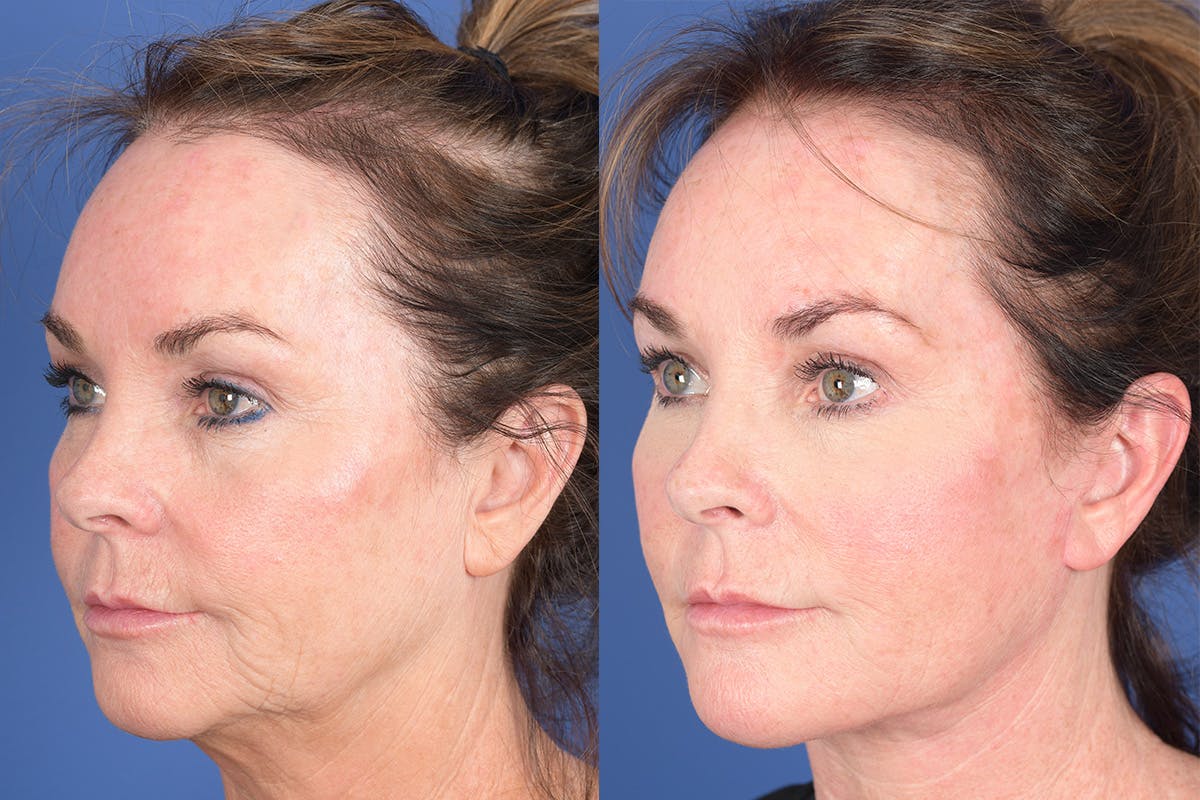 Facelift Before & After Gallery - Patient 381496 - Image 3