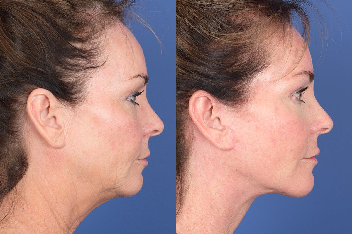 Facelift Before & After Gallery - Patient 381496 - Image 4