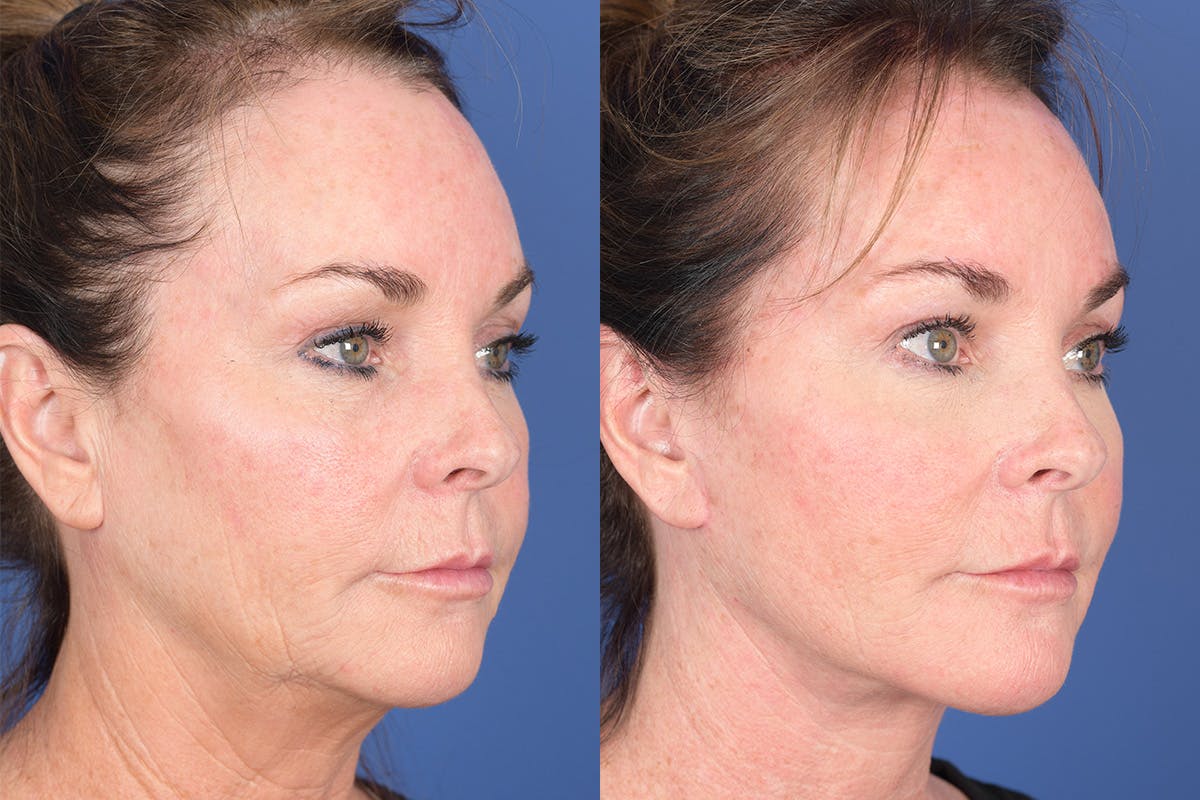 Facelift Before & After Gallery - Patient 381496 - Image 5