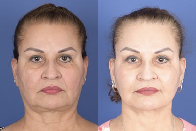 Facelift Before & After Gallery - Patient 307780 - Image 1