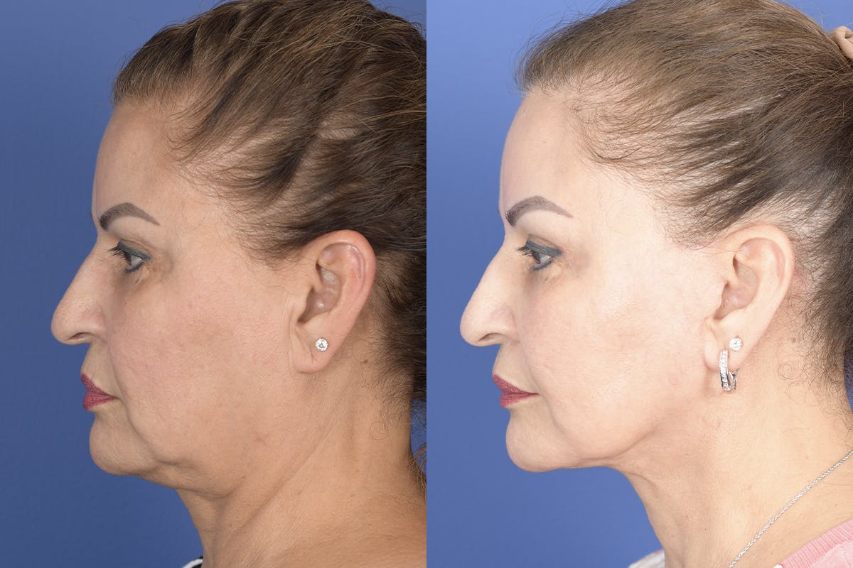 Facelift Before & After Gallery - Patient 307780 - Image 2