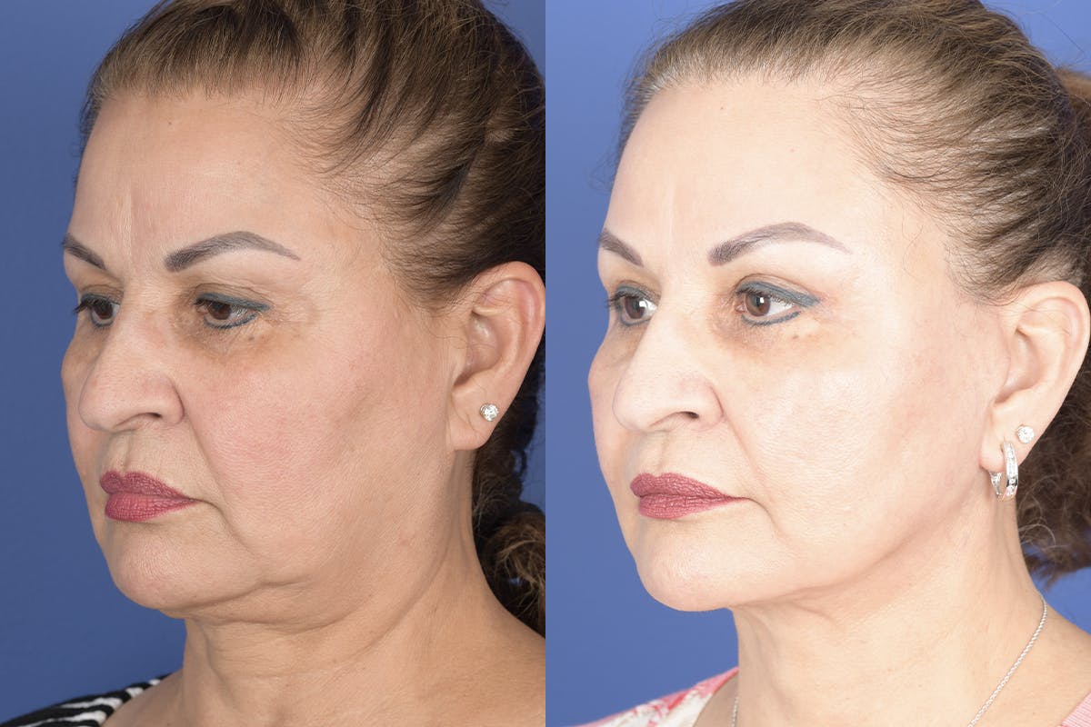 Facelift Before & After Gallery - Patient 307780 - Image 3