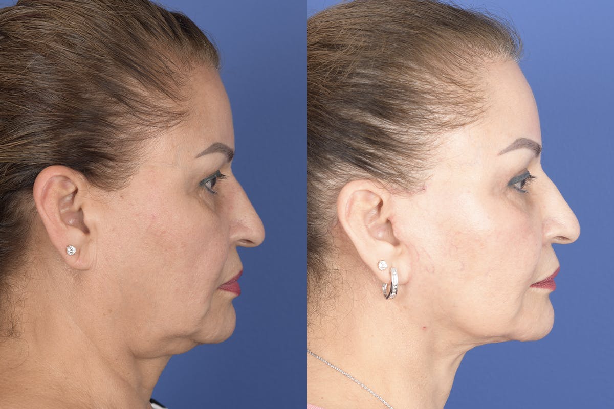 Facelift Before & After Gallery - Patient 307780 - Image 4