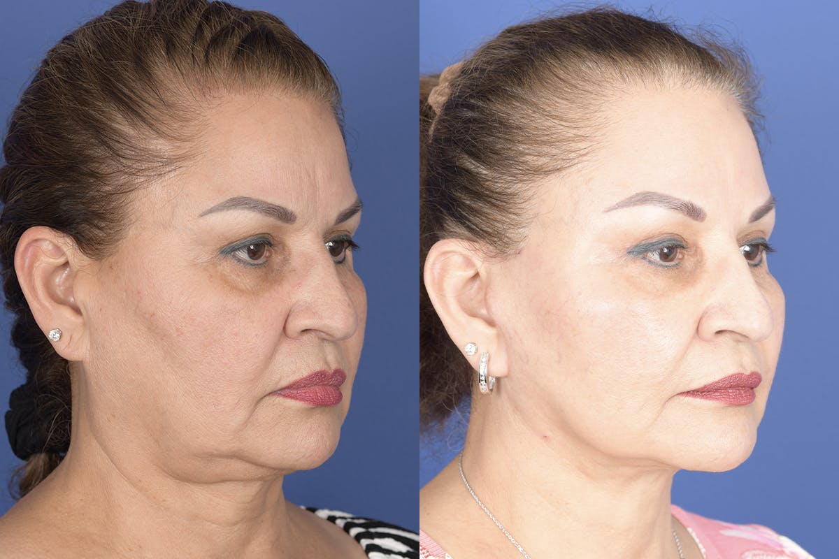 Facelift Before & After Gallery - Patient 307780 - Image 5