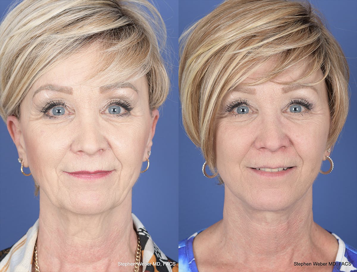 Facelift Before & After Gallery - Patient 419292 - Image 1