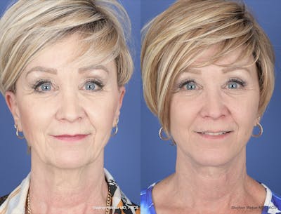 Facelift Before & After Gallery - Patient 419292 - Image 1